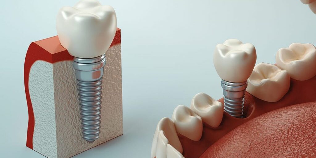 dientes-perdidos-protesis-fijas-clinica-dental-estudio dientes-perdidos-protesis-fijas-clinica-dental-estudio