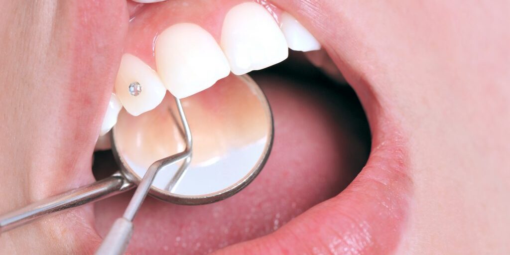 grillz-adornos-dentales-clinica-dental-estudio