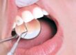 grillz-adornos-dentales-clinica-dental-estudio