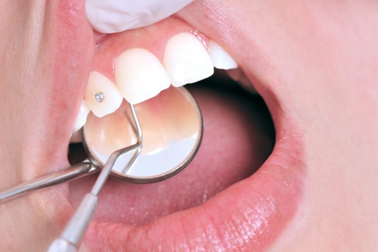 grillz-adornos-dentales-clinica-dental-estudio grillz-adornos-dentales-clinica-dental-estudio