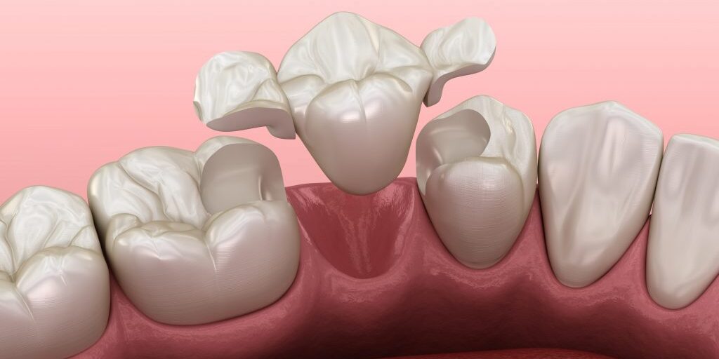 reconstrucción-dental-clinica-dental-estudio reconstrucción-dental-clinica-dental-estudio