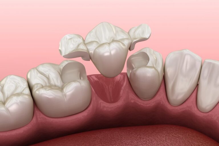 reconstrucción-dental-clinica-dental-estudio reconstrucción-dental-clinica-dental-estudio