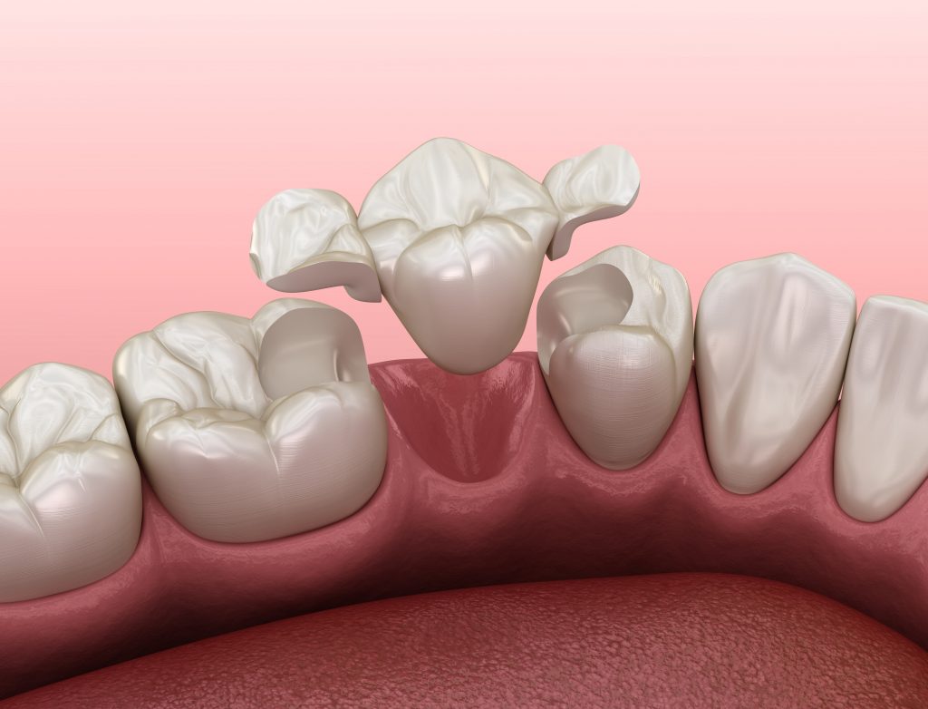 ¿Qué es una reconstrucción dental? Clinica Dental Estudio Dental