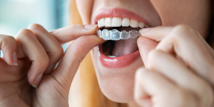 Consejos que debes seguir si acabas de empezar un tratamiento de ortodoncia