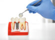 ¿Puedo sufrir el rechazo de un implante dental?