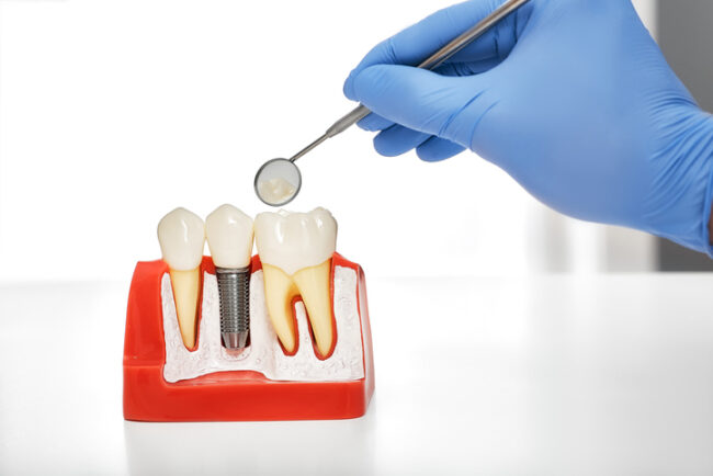 ¿Puedo sufrir el rechazo de un implante dental? ¿Puedo sufrir el rechazo de un implante dental?