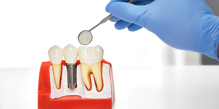 ¿Puedo sufrir el rechazo de un implante dental?