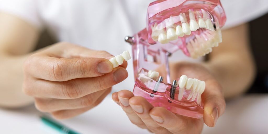 Implantes-puentes-dentales-clinica-dental-estudio Implantes-puentes-dentales-clinica-dental-estudio