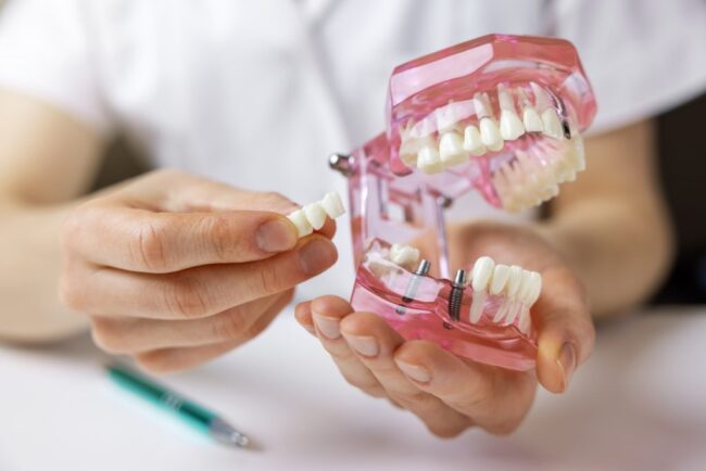 Implantes-puentes-dentales-clinica-dental-estudio Implantes-puentes-dentales-clinica-dental-estudio