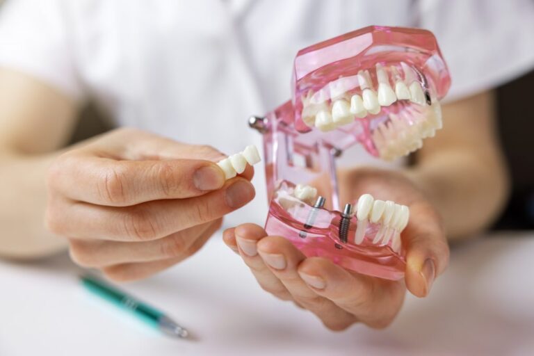 Implantes-puentes-dentales-clinica-dental-estudio Implantes-puentes-dentales-clinica-dental-estudio