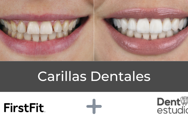 Carillas Dentales