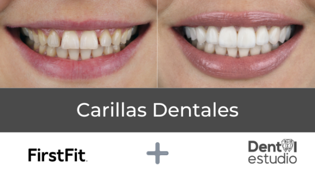 Carillas Dentales